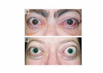[의학과][내분비내과] Graves` Disease-13