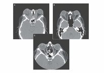 [의학과][내분비내과] Graves` Disease-14