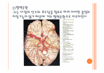 뇌졸중(Stroke) 레포트-7