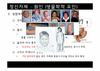 [이상심리] 정신지체 & 학습장애 특징, 치료 방법 및 사례 연구-19