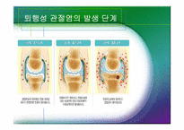 [체육과건강] 관절염(Arthritis)-8