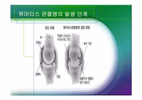 [체육과건강] 관절염(Arthritis)-10