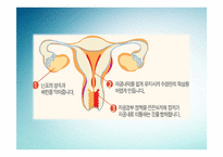 [성심리학] 피임의 역사, 조건, 종류-8