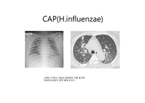 [감염학] CAP의 흉부방사선소견-2