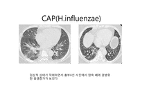 [감염학] CAP의 흉부방사선소견-3