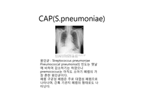 [감염학] CAP의 흉부방사선소견-9