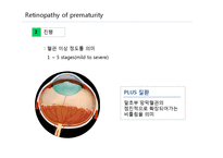 [작업치료학] 미숙아 망막증(Retinopathy of prematurity)-3