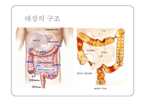 대장암 레포트-2