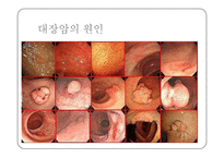 대장암 레포트-5