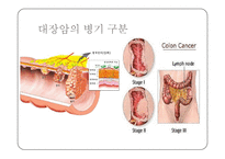 대장암 레포트-11