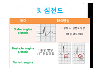 [건강과 간호] 관질환(Coronary Artery Disease) PBL-19