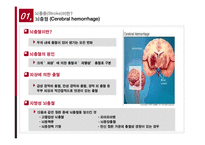 뇌졸중의 치료와 예방-6
