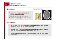 뇌졸중의 치료와 예방-7