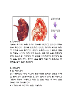 APN 급성신우신염 report-6