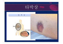 [아동간호학] 영유아 외상 종류와 치료 및 예방법-14
