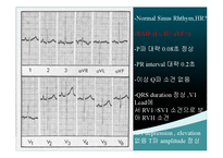 [의학] 팔로증후군TOF 심장질환 아이의 수술과 수술후 육아계획-5