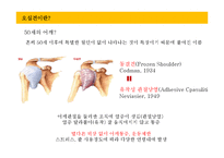 [가족과 건강] 오십견의 증상과 예방-4