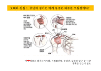 [가족과 건강] 오십견의 증상과 예방-8