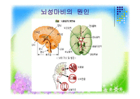 [사회복지] 뇌병변 장애의 판정과 극복-8