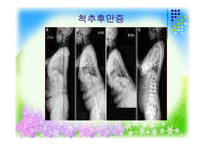 [사회복지] 지체장애의 진단과 극복-17