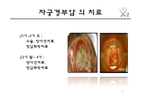 자궁경부암의 원인 및 예방과 치료-20