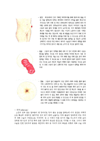 [장애인복지론] 장루 요루 장애-12
