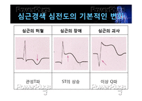 [간호학] 심근경색의 진단 및 간호과정-16