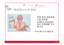 [언어병리] 교차실어증과 언어중추검사(Wada Test)-18