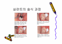 [치의학] 치면열구 전색제를 오래 유지하는 방법-3