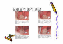 [치의학] 치면열구 전색제를 오래 유지하는 방법-4