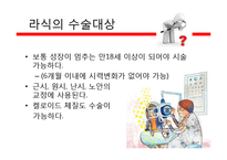 라식, 라섹 수술의 장단점과 부작용 정보-5