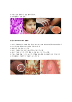 성병(Venereal disease)의 사례와 종류 및 예방-7