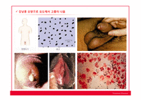 성병(Venereal disease)의 사례와 종류 및 예방-13
