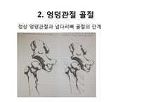 엉덩관절 골절과 무릎관절 치환술-9