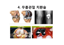 엉덩관절 골절과 무릎관절 치환술-14