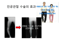 엉덩관절 골절과 무릎관절 치환술-17