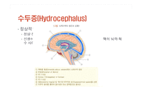 [간호학] 수두증 실습-5