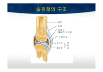 TKA 수술 간호 레포트-15