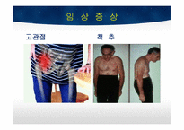 TKA 수술 간호 레포트-19