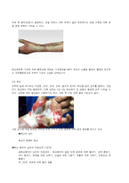 의료사회복지 화상환자 접근-6