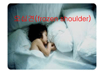 [의학] 오십견[frozen shoulder]에 관해-1