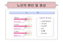 [의학간호학기초] 시각장애 - 녹내장-4