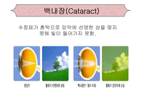 [의학간호학기초] 시각장애 - 녹내장-15