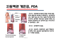 [의학] 선천성 심장질환[Congenital heart disease]에 관해-14