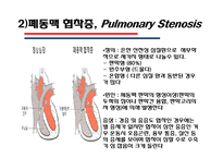 [의학] 선천성 심장질환[Congenital heart disease]에 관해-16