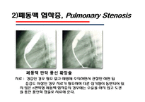 [의학] 선천성 심장질환[Congenital heart disease]에 관해-17