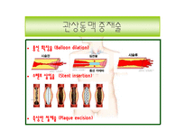 해부생리학 - 심근경색[Myocardial Infarction]에 대해-10