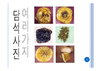 [병리학] 담석증에 관해-4