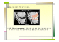 [의학] 반월상 연골판 손상-9