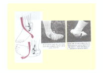 [스포츠 물리치료학] 내번 발목 염좌[inversion ankle sprain]-13